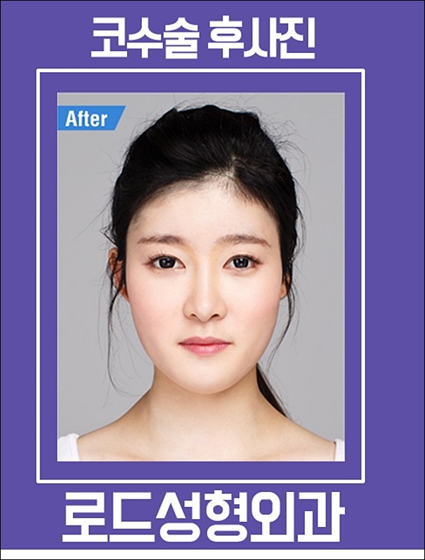 화곡동코성형 부드러운 라인 완성, 로드성형외과! 관련 이미지 4