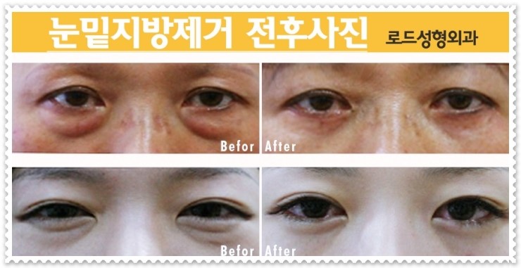 화곡동눈밑지방제거 다크해결_로드성형외과 관련 이미지 2