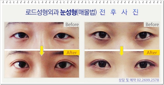 화곡역쌍커풀수술 우아하게 만들기 관련 이미지 2
