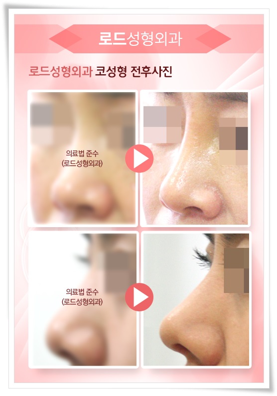 까치산역코수술 어느 각도에서도 자신있게! 관련 이미지 3