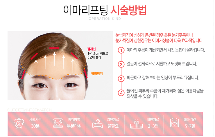 [화곡동성형외과 로드성형외과에서 알려드리는 이마리프팅 정보 ♬] 관련 이미지 3