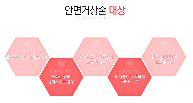 [화곡성형외과 로드성형외과에서 알려드리는 안면거상술 정보 ♬] 관련 이미지 2