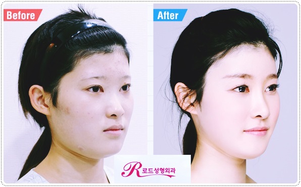 강서구코성형으로 원하는 스타일을 찾자! 관련 이미지 4