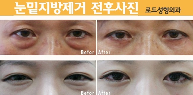 화곡동눈밑지방제거! 로드성형외과에서 달라지다! 관련 이미지 3