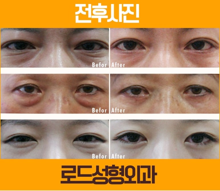 신정역눈밑지방제거는 로드에서 효과보자! 관련 이미지 2