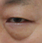 강서구눈밑성형 ♬ 눈밑지방제거 로드성형외과 관련 이미지 3