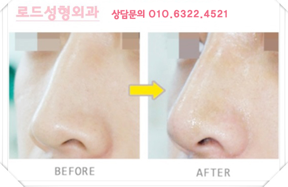 까치산역코재수술 고난이도의 기술력 관련 이미지 4