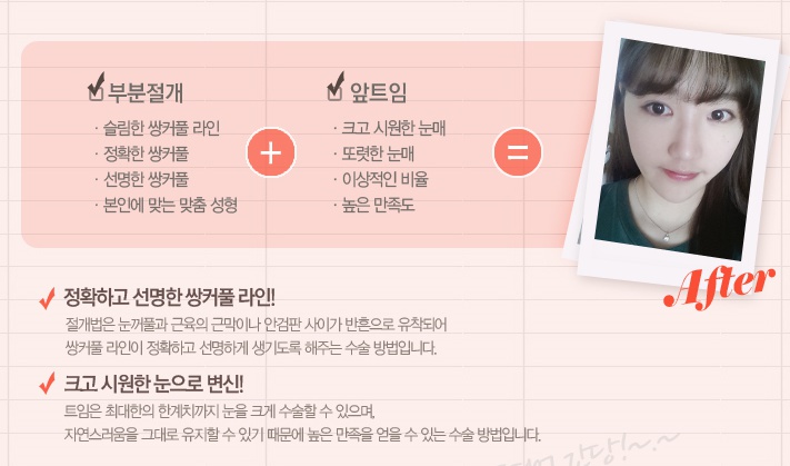 까치산역쌍꺼풀수술은 로드에서 만족! 관련 이미지 3