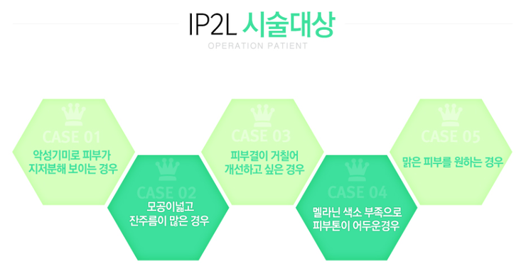[화곡역성형외과 로드성형외과에서 알려드리는 I2PL 정보 ♬] 관련 이미지 2