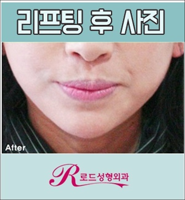 까치산역리프팅 깔끔함 높이는 로드 관련 이미지 4