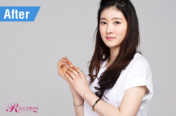 목동코성형 날렵하고 오똑하게 관련 이미지 2