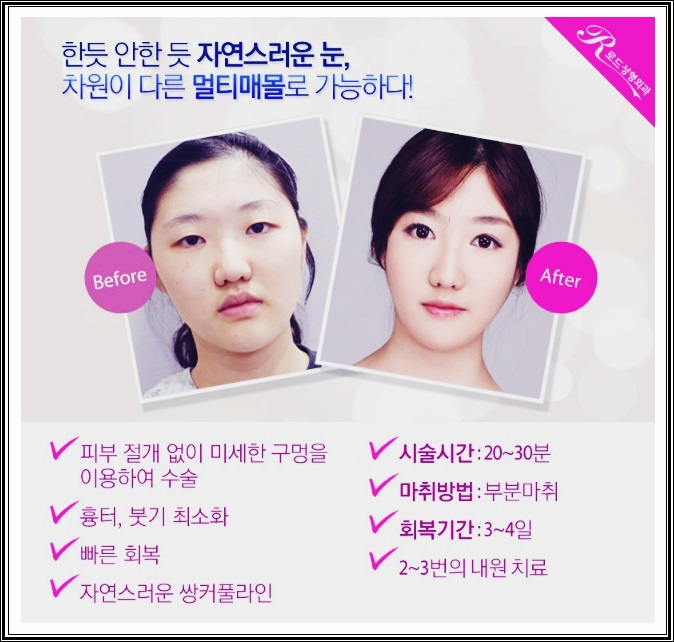 까치산역쌍꺼풀수술 기회를 잡아라! 관련 이미지 3