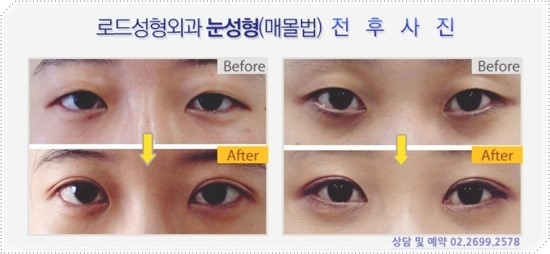 강서구성형외과 로드의 쌍꺼풀 놀랍다!! 관련 이미지 2