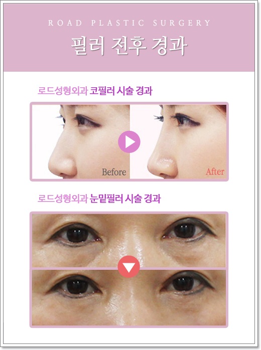 강서구필러 콧대를 높여줘요! 관련 이미지 3