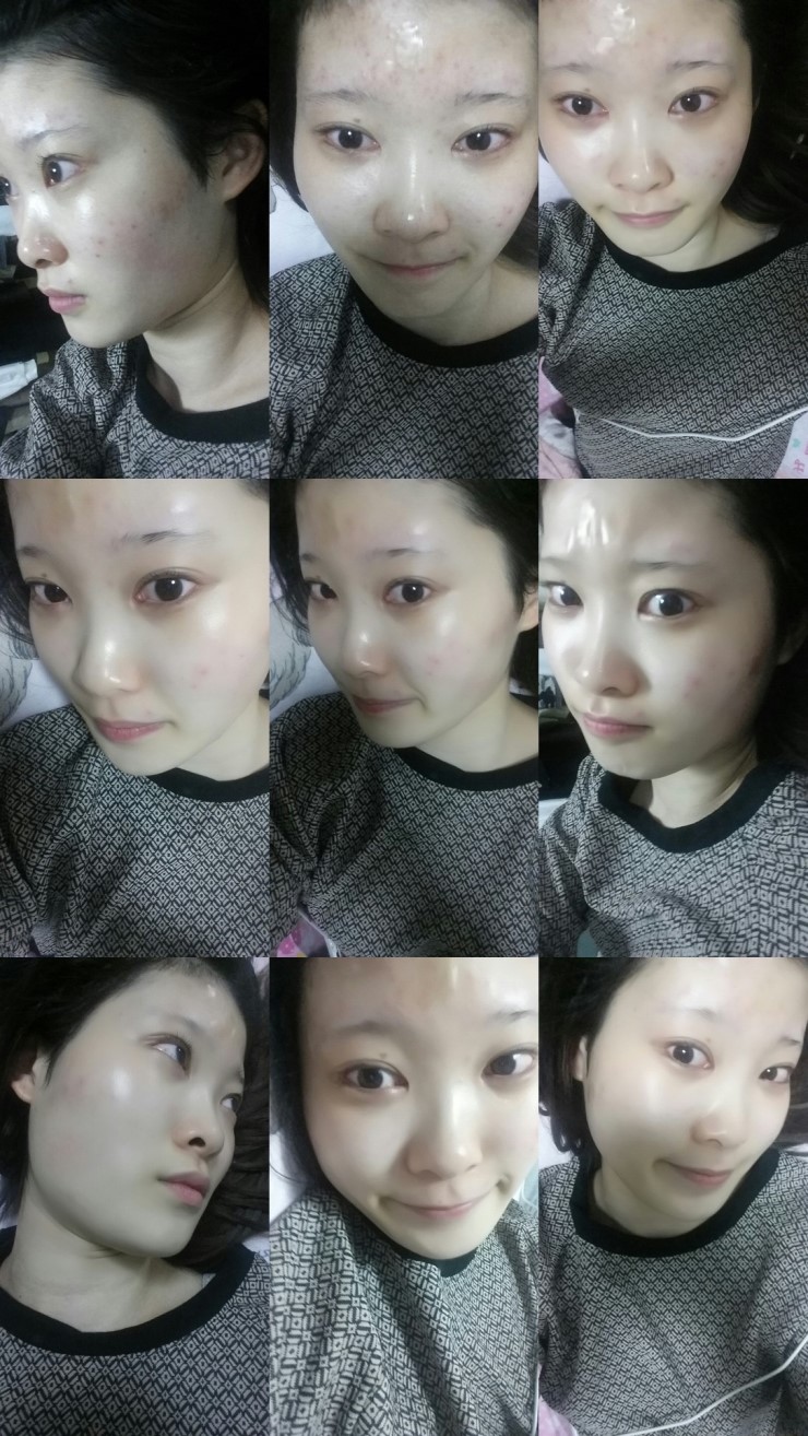 [로드성형외과] 진희의 이마지방이식, 코성형 후기! 관련 이미지 3