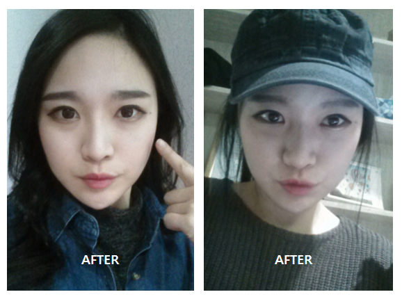 [까치산역성형외과 로드성형외과에서 알려드리는 지방이식 정보 ♬] 관련 이미지 6