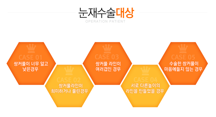 [화곡동성형외과 로드성형외과에서 알려드리는 눈재수술 정보 ♬] 관련 이미지 3