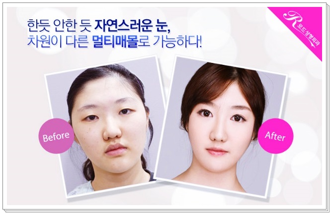 목동눈성형 반짝 빛나게 관련 이미지 2