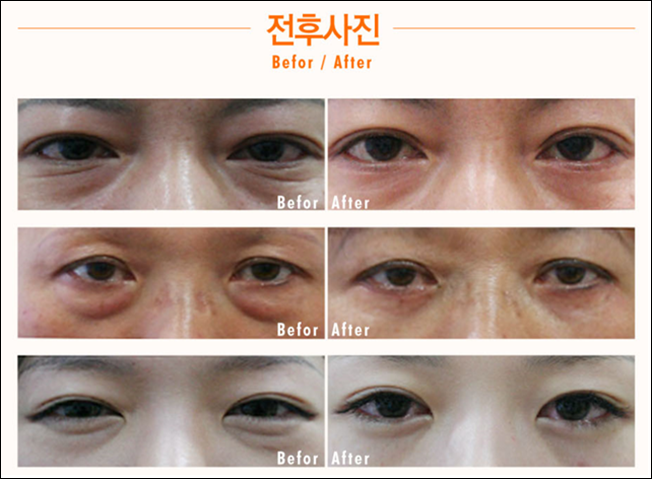 강서구눈밑지방제거 로드에서 산뜻 눈매 완성 관련 이미지 2