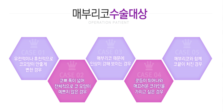 [까치산성형외과 로드성형외과에서 알려드리는 매부리코성형 정보 ♬] 관련 이미지 2