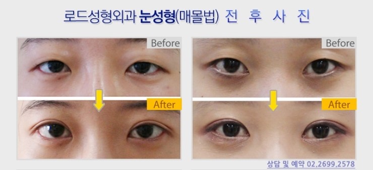 강서구성형외과◎ 로드에서 쌍꺼풀수술 확인해보세요~ 관련 이미지 2
