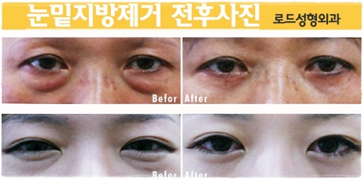 로드성형외과* 목동역에서 눈(다크) 해결했다 :] 관련 이미지 2