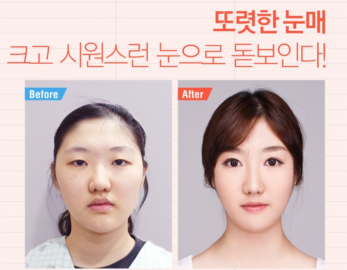 까치산역쌍꺼풀수술은 로드에서 만족! 관련 이미지 1