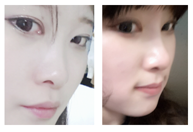 [화곡동성형외과 로드성형외과에서 알려드리는 낮은코성형 정보 ♬] 관련 이미지 5