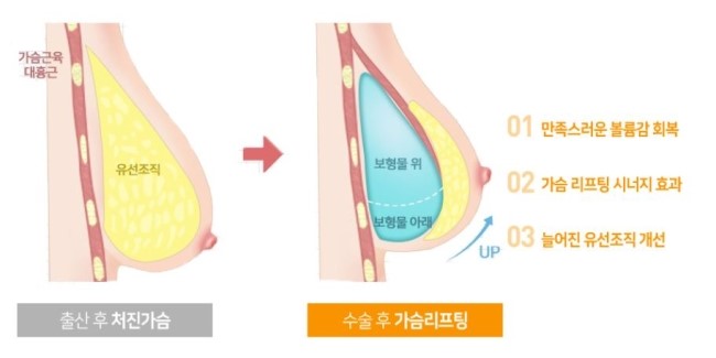 마곡지구가슴성형 만족스러운 몸매라인으로 관련 이미지 3