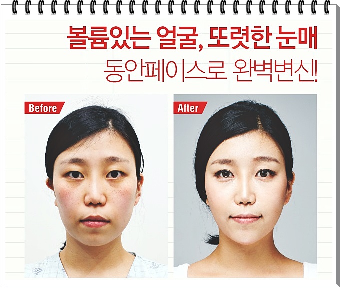 화곡동지방이식 탄력을 더하기 관련 이미지 3