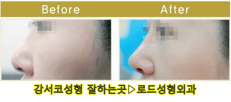 [로드성형외과] 강서코성형 잘하는곳! 관련 이미지 2