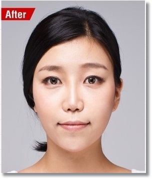 까치산역지방이식잘하는곳 여기가 안전 관련 이미지 4