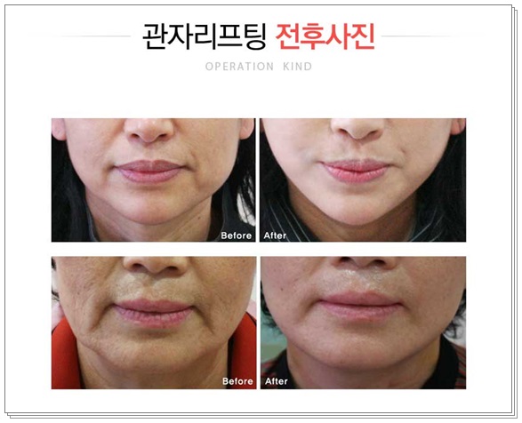 강서구리프팅 감출 수 없는 미모 관련 이미지 2
