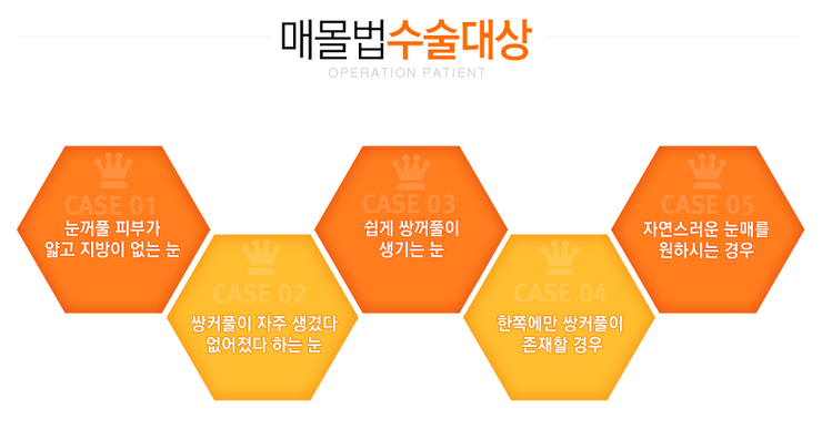 [까치산역성형외과 로드성형외과에서 알려드리는 눈성형 정보 ♬] 관련 이미지 3