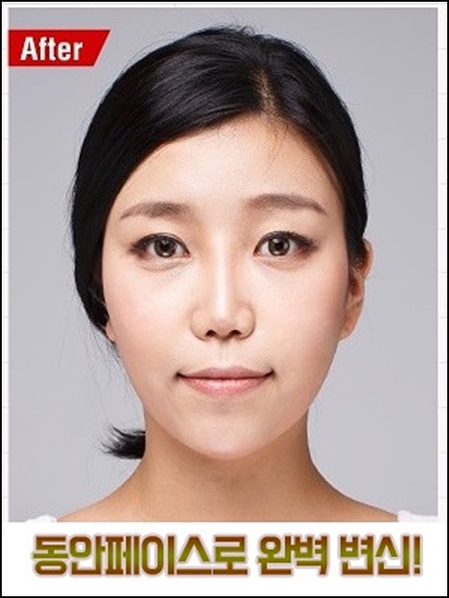 화곡역지방이식 원하는 볼륨감 경험, 로드성형외과 관련 이미지 4
