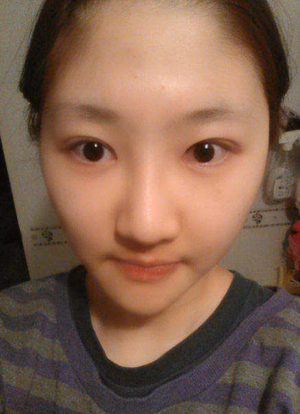 [까치산성형외과 로드성형외과에서 알려드리는 트임성형 정보 ♬] 관련 이미지 7