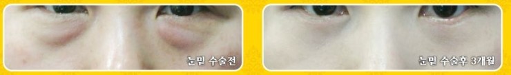 강서구눈밑지방성형 잘하는곳 ♬ 아이리스/로드성형외과 관련 이미지 3