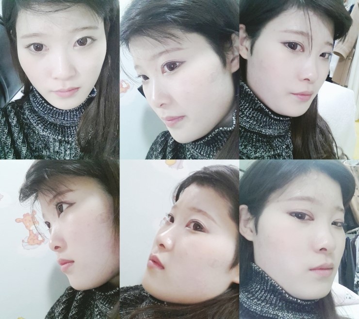 [로드성형외과] 진희의 이마지방이식, 코성형 후기! 관련 이미지 2