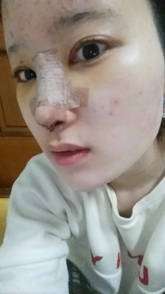 [로드성형외과] 진희의 이마지방이식, 코성형 후기! 관련 이미지 3