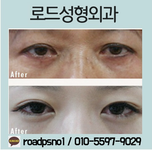 화곡동눈밑필러유명한곳 알아보자 관련 이미지 3