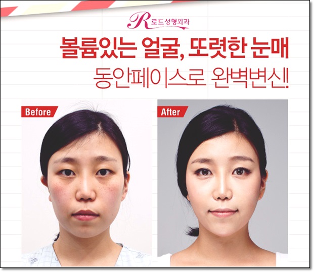 화곡역지방이식 변화를 꿈꾼다면 관련 이미지 4