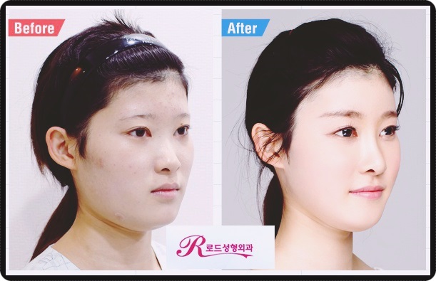 화곡역코수술 잘하는 곳으로 가볼까요? 관련 이미지 3