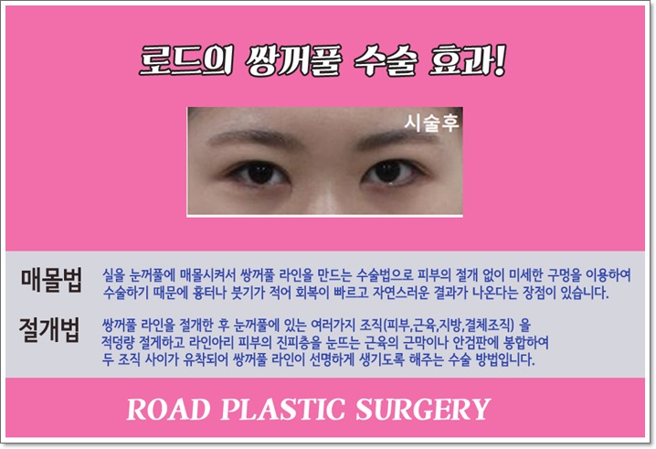 신정역매몰쌍꺼풀수술은 로드에서! 선명한 라인 관련 이미지 3