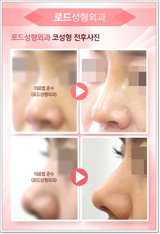 목동코수술 자연스러움이 최고에요! 관련 이미지 3