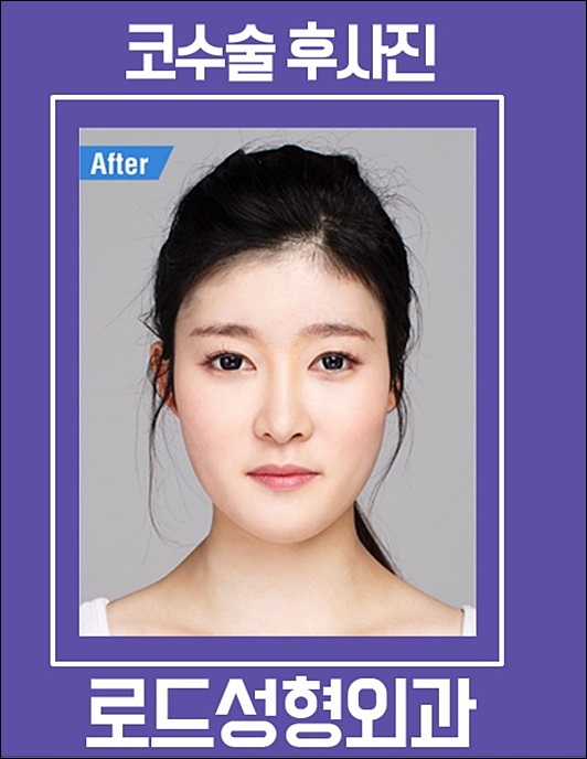 화곡동코필러 예쁜 모양 완성! 로드성형외과 관련 이미지 4