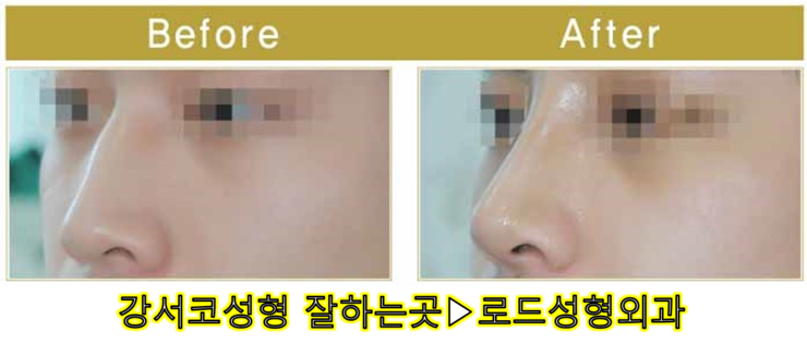 [로드성형외과] 강서코성형 잘하는곳! 관련 이미지 4