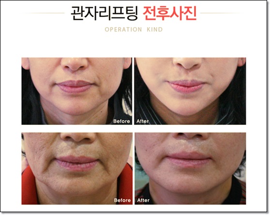 화곡동리프팅으로 살아있는 라인을 관련 이미지 2
