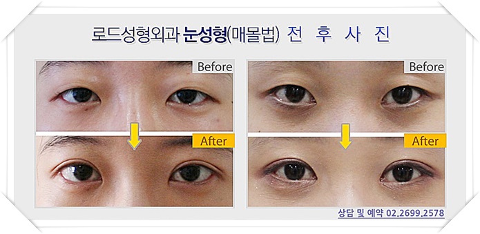 화곡동쌍꺼풀수술 깜짝 놀라다 관련 이미지 2
