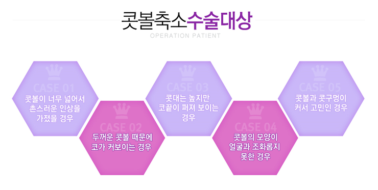 [까치산성형외과 로드성형외과에서 알려드리는 콧볼축소 정보 ♬] 관련 이미지 2