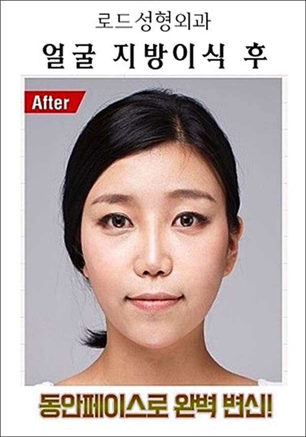 화곡동지방이식 볼륨감을 살리는 로드성형외과 관련 이미지 3